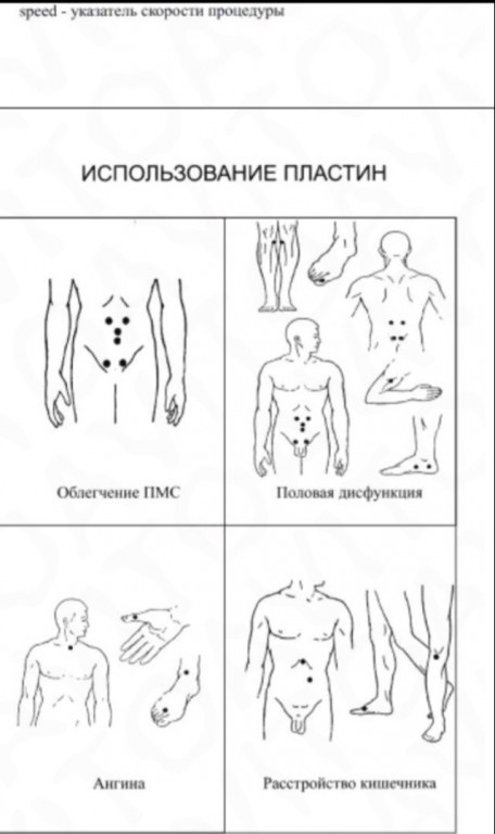 Миостимуляция ягодиц схема наложения электродов